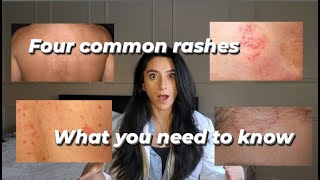 Four common rashes and everything you need to know about them [upl. by Aksel]