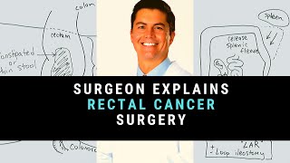 Surgeon Simply Explains Colon Cancer Surgery [upl. by Aicarg]