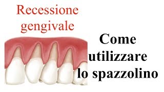 Come utilizzare lo spazzolino in caso di recessione gengivale [upl. by Finstad800]