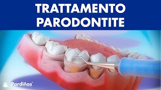 Trattamento parodontite – Curettage e sondaggio parodontale © [upl. by Analak]