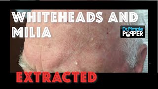 Whiteheads and milia extracted after Mohs surgery [upl. by Tica559]