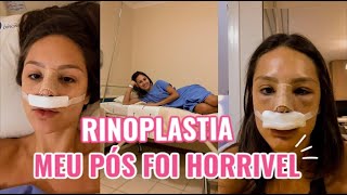 Minha Rinoplastia  como foi o pós COM FOTOS [upl. by Yecaj]