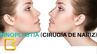 Rinoplastia  cirugía plástica de la nariz [upl. by Ahsilat]