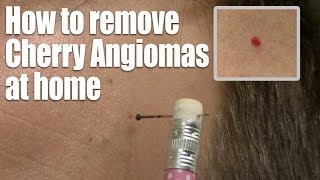 How to remove Red Skin Dots at home Quick amp Easy Cherry Angioma treatment [upl. by Aihsekyw]