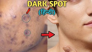 How To Remove DARK SPOTS From Face Naturally  ACNE SCARS BLACK SPOTS ACNE MARKS  Style Saiyan [upl. by Stefa]