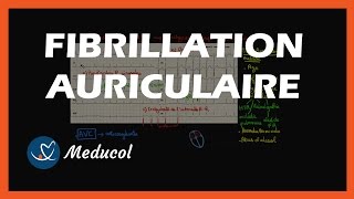 La Fibrillation Auriculaire Définition et Symptômes [upl. by Neltiak]