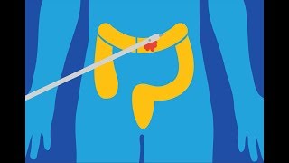 Hemorrhoid Banding with Dallas Colorectal Surgeon Dr Anthony Macaluso [upl. by Refinaj]