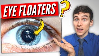 3 Must Know Facts About EYE Floaters [upl. by Macrae]