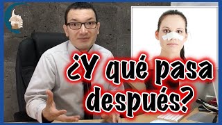 CUIDADOS después de una RINOPLASTÍA 😰👃🏻🤕  PlasticFacial MX [upl. by Annotahs]