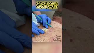 Cystic Acne Removal amp Inflammatory Acne [upl. by Onilecram650]