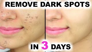 In 3 DAYS  Remove DARK SPOTS BLACK SPOTS amp ACNE SCARS  Anaysa [upl. by Maximilien]