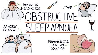 Obstructive Sleep Apnoea [upl. by Flemming]