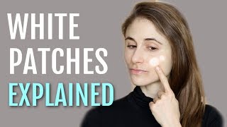 WHITE PATCHES ON THE FACE EXPLAINED PITYRIASIS ALBA DR DRAY [upl. by Anaujal]