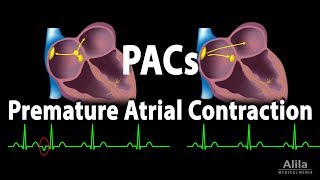 Premature Atrial Contractions PACs Animation [upl. by Amilb]