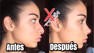 RINOPLASTIA CASERA EN MINUTOS  RESPINGADORES PARA NARIZ BONITA [upl. by Gan685]