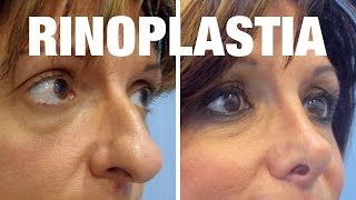 Rinoplastia Antes y Después  Tratamiento de Ana Isabel [upl. by Elwee263]